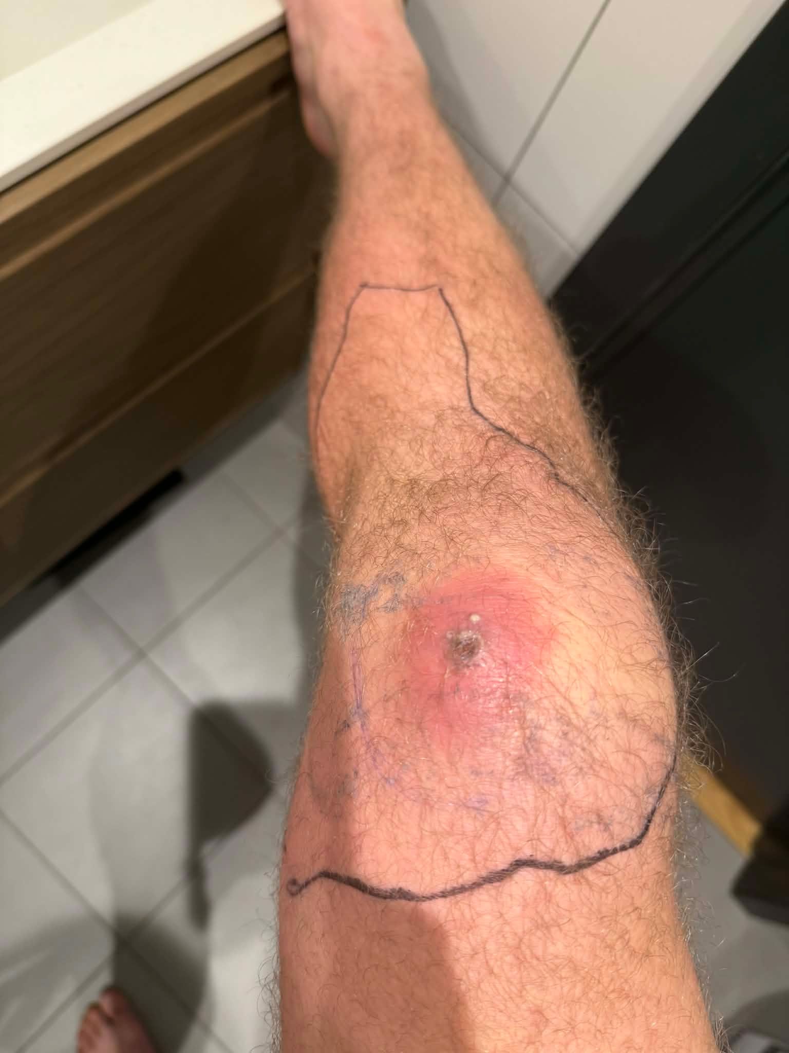 Jon Vetle Furuheim wycofany z walki MMA z powodu poważnej infekcji. Spędził kilka dni w szpitalu